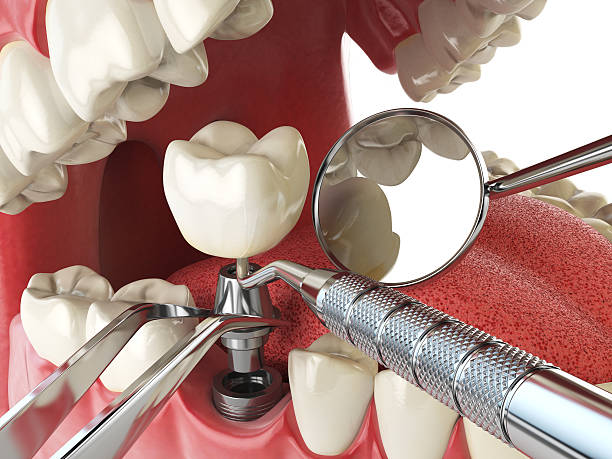 Best Emergency Wisdom Tooth Extraction in Montvale, NJ